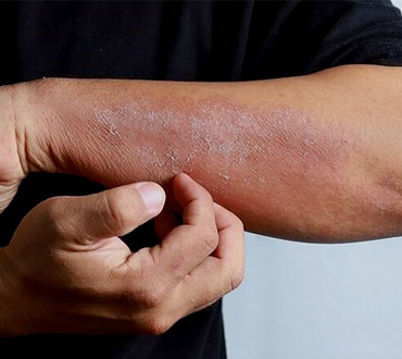 کرونا تاثیری روی پوست داره؟