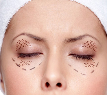 پلاسما جت راهی جدید برای لیفت صورت و درمان مشکلات پوستی